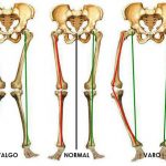 alinhamento do joelho